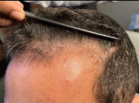exosomes hair restoration before